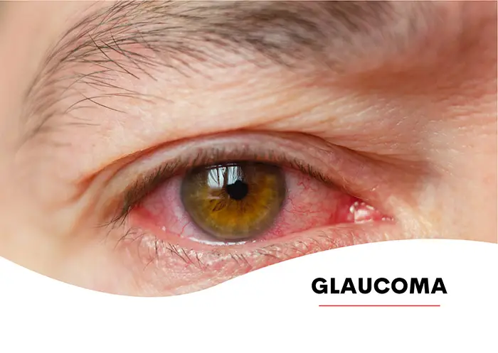 Diagnóstico e Tratamento de Glaucoma é na Vítrea Hospital de Olhos